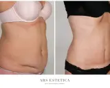 Ile kosztuje liposukcja brzucha? Pełny cennik i ukryte koszty