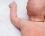 Drobne czerwone krostki na ciele dziecka, widoczne na plecach i karku, mogą być powodem do niepokoju rodziców.