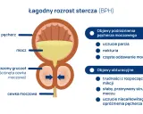 Ilustracja przedstawia łagodny rozrost stercza (BPH), gdzie powiększony gruczoł uciska cewkę moczową, powodując objawy takie jak trudności z oddawaniem moczu. To może być powód, gdzie boli prostata.