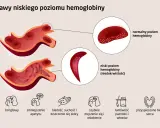 Ilustracja porównująca prawidłowe i nieprawidłowe krwinki czerwone oraz objawy niskiego poziomu hemoglobiny.