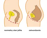 Normalne jelito z uśmiechniętą kupką vs. zatwardzenie z płaczącą kupką, co powoduje ból przy robieniu kupy.
