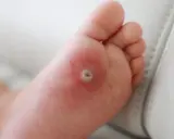 Dziecko ma kurzajkę na stopie, która jest widoczna na podeszwie.