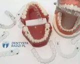 Aparaty na zęby: Rodzaje, ceny i jak podjąć najlepszą decyzję?