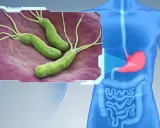 Bakterie Helicobacter pylori w żołądku. Dowiedz się, jak wyleczyć helicobacter.