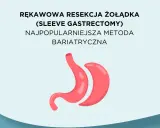 Rękawowa resekcja żołądka, najpopularniejsza metoda bariatryczna, przedstawiona jako stylizowany obraz żołądka.