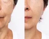 Comparaison avant/après : peau marquée par les rides du sommeil d'un côté, peau plus lisse et rajeunie de l'autre.