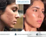 Prima e dopo un trattamento co2 laser viso per acne e imperfezioni. Pelle visibilmente più liscia e luminosa.