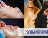 Prima e dopo un intervento per correggere il doppio mento. Immagini ravvicinate del viso di una persona durante una procedura medica.