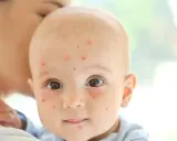 Un bébé est tenu par sa mère, son visage est couvert de petites taches rouges de varicelle.