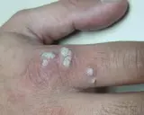 Verrugas en la mano, con aspecto escamoso y blanquecino. La diferencia entre verruga y condiloma es importante para el diagnóstico.