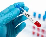 Ręka w niebieskiej rękawiczce trzyma probówkę z napisem "CRP - TEST". Badanie CRP pomaga ocenić stan zapalny w organizmie.