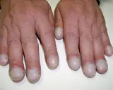 Dita gonfie e unghie arrotondate, segni che possono indicare fibrosi cistica alle mani.