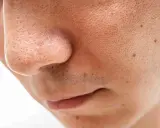 Gros plan sur un nez et une bouche, montrant des pores dilatés et quelques points noirs sur le visage.