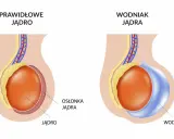 Porównanie prawidłowego jądra z jądrem dotkniętym wodniakiem. Wodniak jądra to nagromadzenie płynu.