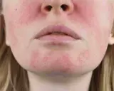 Une tache rouge sur le visage, près des lèvres et des joues, suggère une irritation cutanée.