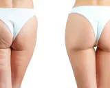 Comparaison avant/après : réduction visible de la cellulite sur les fesses, peau plus lisse et ferme.