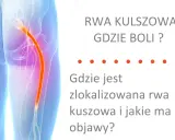 Ból kręgosłupa lędźwiowego promieniujący do nóg - rwa kulszowa. Ilustracja pokazuje przebieg nerwu kulszowego.