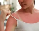 Épaule rouge vif, marquée par une cicatrice soleil due à un coup de soleil. La peau est irritée, témoignant d'une exposition excessive au soleil.