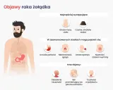 Objawy raka żołądka: utrata masy, czarne stolce, uczucie pełności, niestrawność, zgaga, utrata apetytu, nudności, wymioty, osłabienie, duszność, ból pleców, trudności w połykaniu. Czy rak żołądka boli? Tak, może powodować ból.