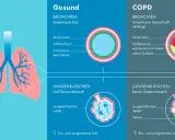 Vergleich gesunder Lungen mit COPD: Verengte Bronchien und defekte Lungenbläschen bei COPD erschweren den Gasaustausch.