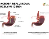 Objawy refluksu u dorosłych: Nie tylko zgaga! Kiedy iść do lekarza?