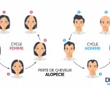 Illustration du cycle de perte de cheveux chez l'homme et la femme, montrant le début de calvitie et l'alopécie.