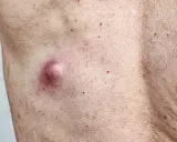 Widoczne grudki perliste u kobiet, jedna z nich jest zaczerwieniona i lekko opuchnięta, otoczona drobnymi czerwonymi kropkami na skórze.