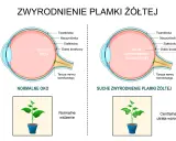 Porównanie normalnego oka z suchym zwyrodnieniem plamki żółtej. Obraz ukazuje zmiany w siatkówce, które mogą prowadzić do obrzęku plamki żółtej i utraty wzroku.