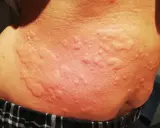 Piel con erupciones rojas y elevadas, posibles síntomas de ácaros en la cama.