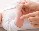 En vuxen pekar på ett litet rött utslag på en bebis arm. Bebisens hud ser lite torr ut.