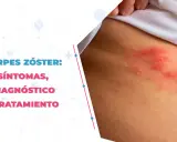 Herpes zóster: Medicamentos esenciales para evitar el dolor crónico