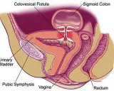 Anatomical diagram showing a colovesical fistula, a connection between the colon and bladder.