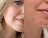 Viso con sfogo cutaneo, forse un'allergia. La pelle presenta rossori e piccole pustole, soprattutto intorno alla bocca e sul mento.