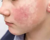 Rostro de niño con erupción roja y escamosa, síntoma del virus del tortazo.