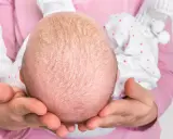 Babykopf mit Schuppen, Anzeichen von trockener Kopfhaut bei Babys.