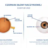 Schemat oka z zaznaczonym czerniakiem naczyniówki i czerniakiem tęczówki.