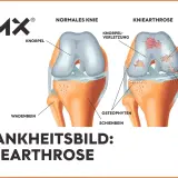 Vergleich von gesundem Knie und Kniearthrose. Die Darstellung zeigt Knorpelverschleiß, Erosionen und Knochenreizungen – eine mögliche "wunderwaffe gegen arthrose knie" könnte hier Abhilfe schaffen.
