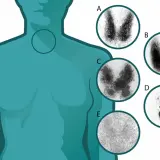Imágenes de gammagrafía tiroidea que muestran la función de la glándula tiroides. El yodo para que sirve es fundamental para la producción de hormonas tiroideas.