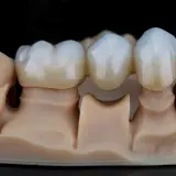 Model szczęki z mostem porcelanowym, imitującym naturalne zęby.