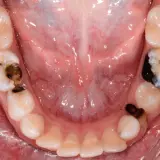 Denti da latte con carie evidenti, alcuni con otturazioni scure.