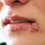 Opryszczka a dentysta: Czy wizyta jest możliwa i bezpieczna?