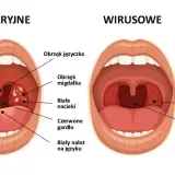 Ból gardła po amfetaminie: przyczyny, objawy i jak szybko przynieść ulgę