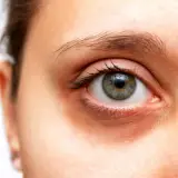 Œil humain avec des cernes visibles sous l'œil, suggérant des solutions pour comment atténuer les cernes.