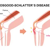 Ilustracja pokazuje rozwój choroby Osgood-Schlatter. Po lewej zdrowa anatomia kolana, po prawej zapalenie więzadła rzepki.