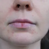 Skóra wokół ust z zaczerwienieniami i wypryskami, wskazująca na zapalenie okoloustne.
