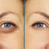 Ojos con ojeras hundidas y arrugas antes y después de un tratamiento.