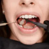 Zbliżenie na usta pacjentki podczas zabiegu ekstrakcji zęba. Dentysta w czarnej rękawiczce używa lusterka i narzędzia.