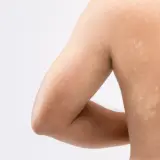 Jasne plamy na skórze pleców, widoczne objawy łupieżu pstrego.