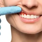 Ból zęba? Czerwone, opuchnięte dziąsła mogą wymagać antybiotyku na zęba. Dentysta bada dziąsła.