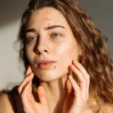 Junge Frau mit Akne im Gesicht, die sich besorgt die Wangen berührt. Mögliche isotretinoin nebenwirkungen.
